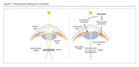 Pilocarpine Hydrochloride Ophthalmic Solution An Innovative