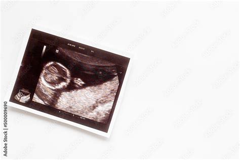 Pregnancy background with ultrasound picture of unborn baby Stock Photo ...