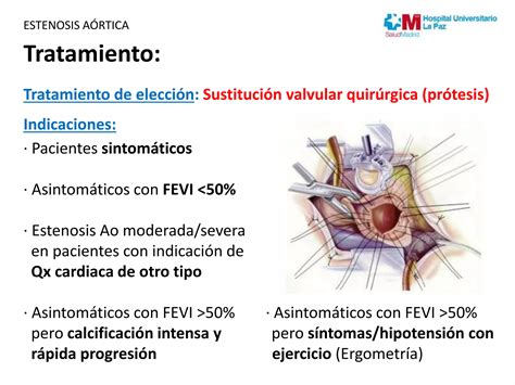 Diagnóstico Y Tratamiento De La Estenosis Aórtica Del Adulto Ppt