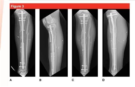 Management Of Segmental Bone Defects Semantic Scholar