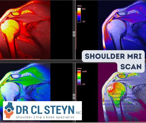 Mri Scans For Shoulder Pain What You Need To Know Twitter