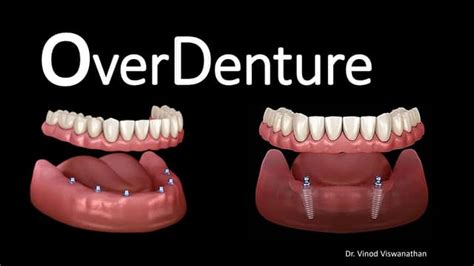 OVERDENTURE.pptx