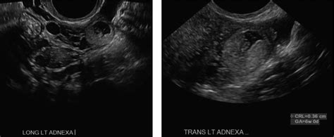 A Transvaginal Ultrasonography Of Left Adnexal Ectopic Pregnancy