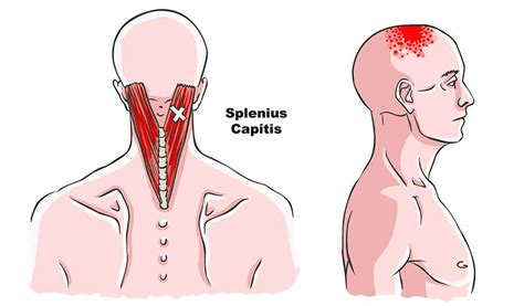 Splenius Capitis Trigger Points