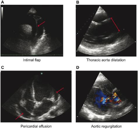 Representative Focused Cardiac Ultrasound Findings Still Images Of