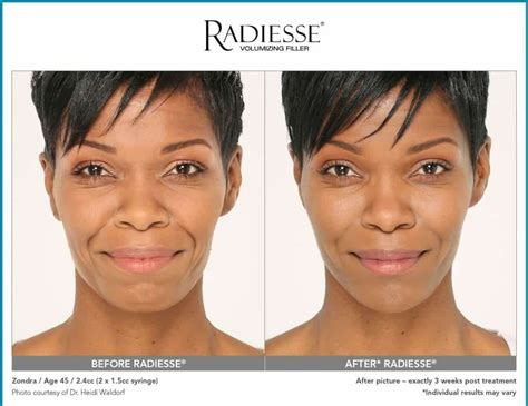 Radiesse Filler Injections Chicago Medspa And Aesthetics