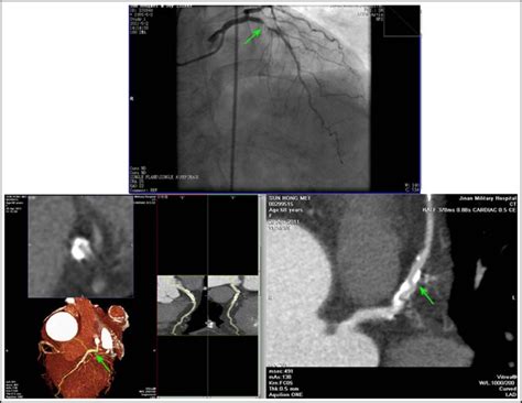 Severe calcification effected judgment of coronary stenosis degree by ...