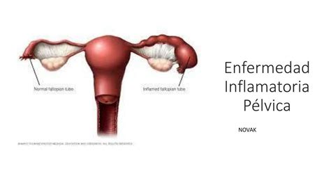 Enfermedad Inflamatoria Pélvica Novak Todo Sobre Medicina Udocz