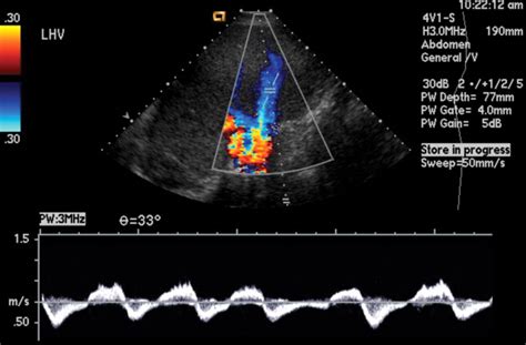 Understanding The Spectral Doppler Waveform Of The Hepatic Veins In