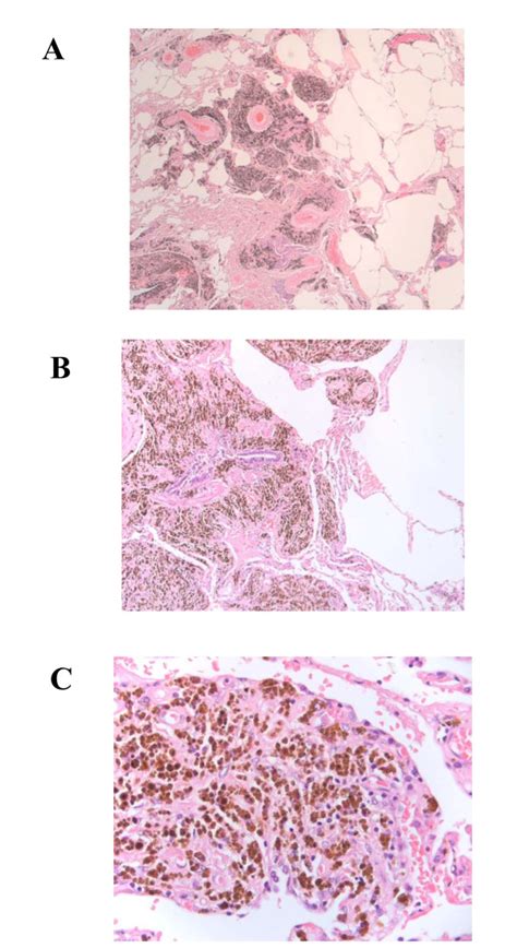 Histological Analysis A Low Power ×100 Micrograph Showing Pigment