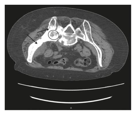 Ct Biopsy Imaging Axial Body View With Slice Thickness 500