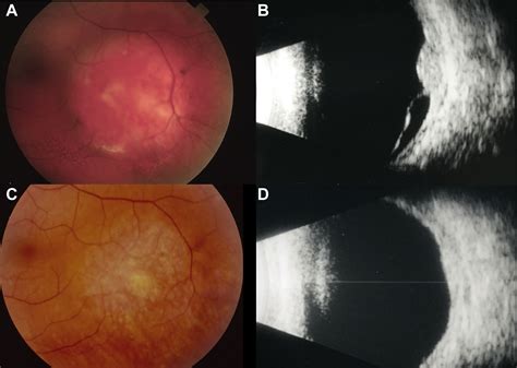 Circumscribed Choroidal Hemangioma Visual Outcome In The Pre