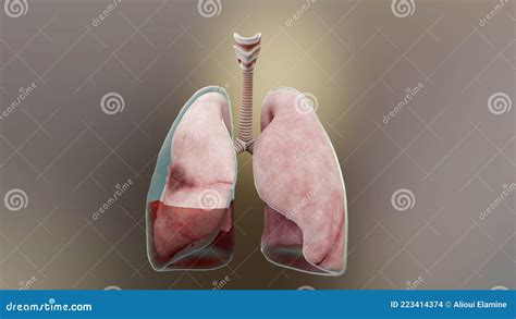 3d Illustration Of Hemopneumothorax, Normal Lung Versus Collapsed, Symptoms Of Hemopneumothorax ...