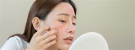 How Are Acne And The Papules And Pustules Of Rosacea Different Florida Academic Dermatology