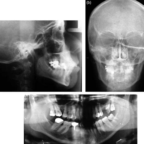 A C Pretreatment Frontal And Lateral Intraoral Views D Overjet