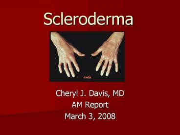 PPT Scleroderma PowerPoint Presentation Free To View Id 416b5a YzdkM