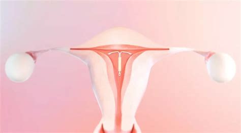 Mirena IUD vs. Hysterectomy: Managing Heavy Menstrual Bleeding