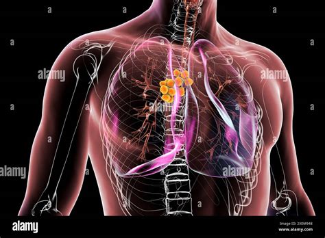 3d Illustration Of Lungs Affected By Mediastinal Lymphadenopathy This