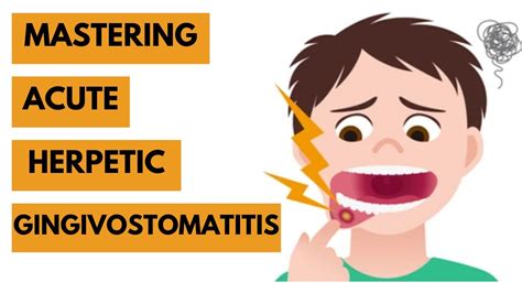 Acute Herpetic Gingivostomatitis Introduction Etiology Clinical