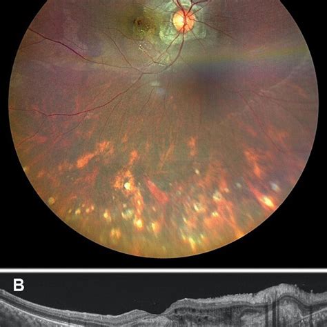 Color Fundus Photograph Clarus Zeiss Of Right Eye Reveals