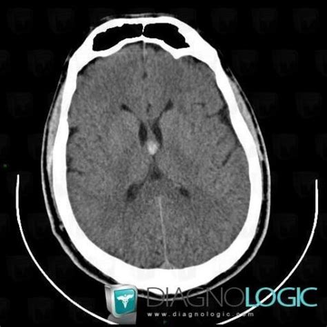 Cas Radiologie Kyste Collo De Scanner Irm Diagnologic