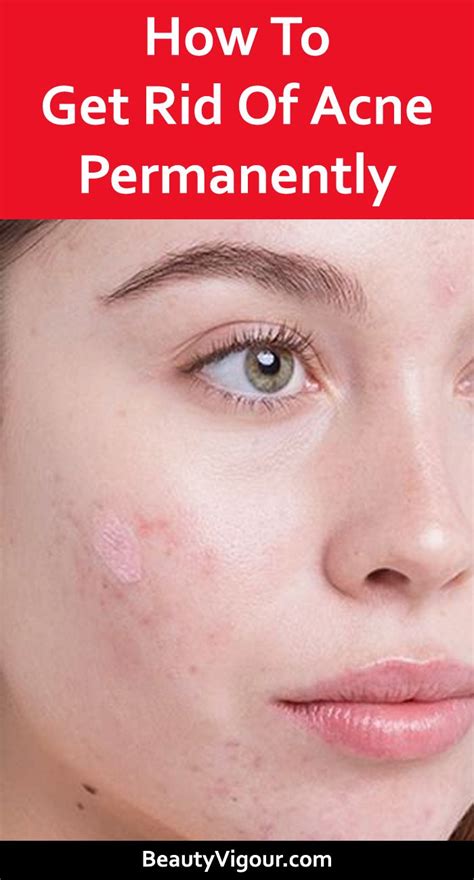 How To Get Rid Of Acne Permanently How To Get Rid Of Acne Natural Facial Skin Care Chest Acne