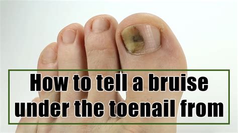 Skin Cancer Under Toenail