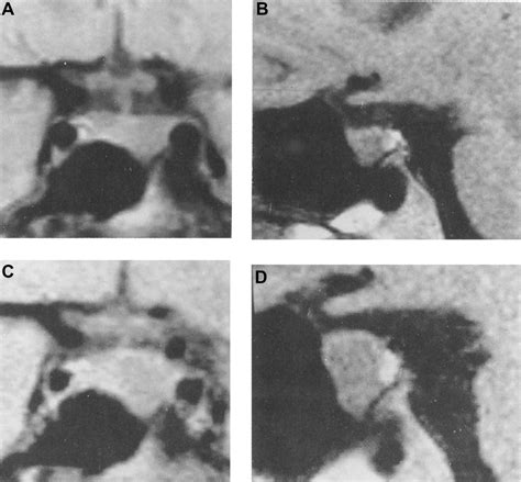 Figure 1 From Prolactinoma In Pregnancy Semantic Scholar