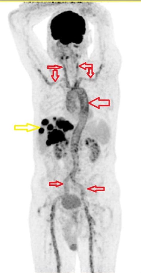 Maximum Intensity Projection Mip Multiple Metastatic Foci In The