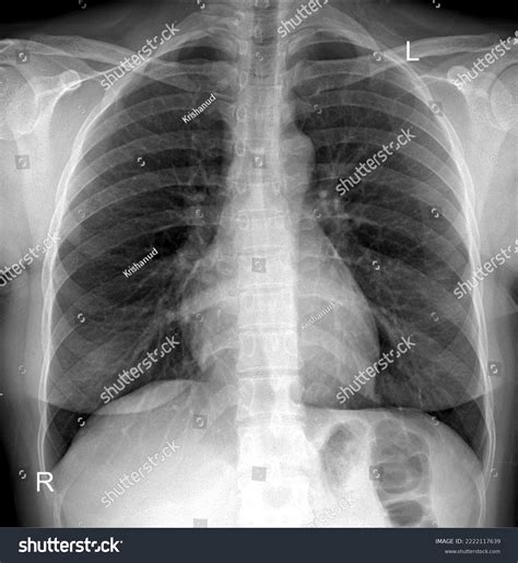 Chest Xray Radiograph Posteroanterior View Foto Stock 2222117639