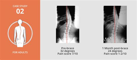 Adult Scoliosis Treatment Scoliosis Centers Of Boston Ma And