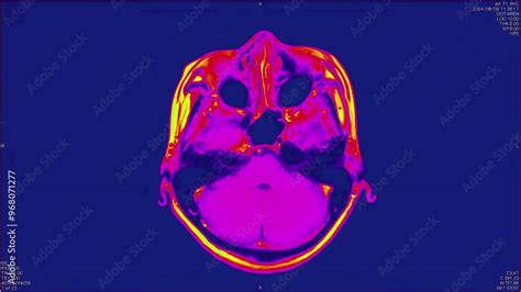 Magnetic Resonance Images Of The Brain Mri Of The Brain Of A Patient