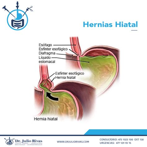 Tratamiento De Hernia Hiatal En Guanajuatao Cu Les Son Los S Ntomas Y