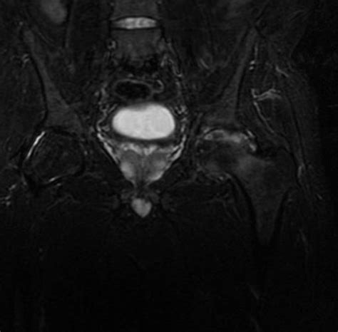 Avascular Necrosis Hip- MRI - Sumer's Radiology Blog