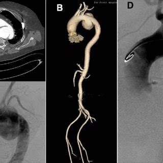 Computed Tomography CT And Computed Tomography Angiography CTA Of