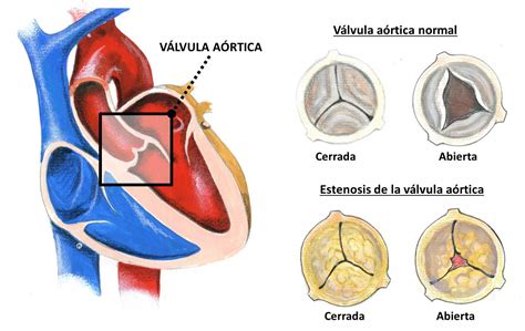 Fisiopatología De La Estenosis De La Válvula Mitral