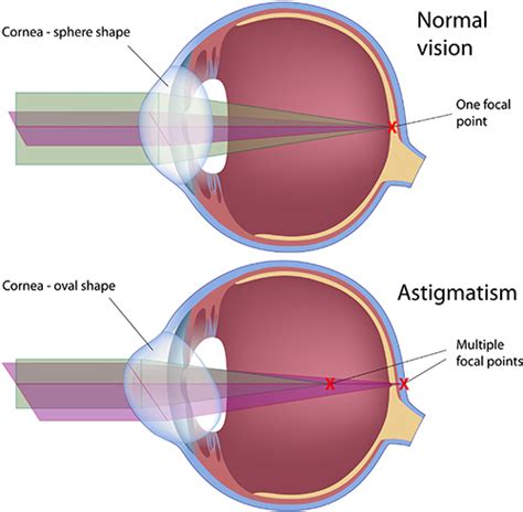 Astigmatism Correction East Valley Ophthalmology Eye Doctors Mesa AZ