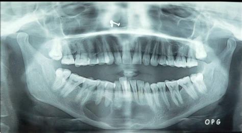 Figure 1 From Multinucleated Giant Cells In Unicystic Ameloblastoma A