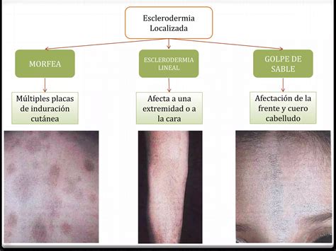 Esclerodermia Esclerosis Sistemica PPT