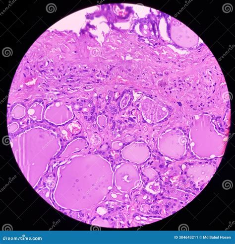 Thyroid Cancer Tracheal Gland Involved By Tumor Metastatic Papillary