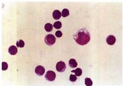 正常淋巴细胞 综合性临床细胞学图 医学