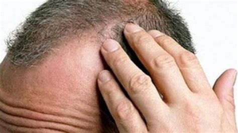 Saçkıran Alopesi Areata nedir