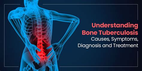 Understanding Bone Tuberculosis: Causes, Symptoms, Diagnosis, and ...