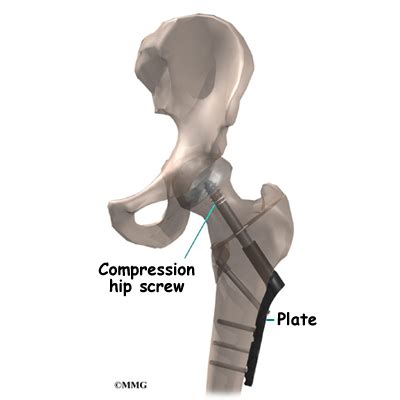 Hip Screw Compression Fixation For A Fractured Hip Orthogate