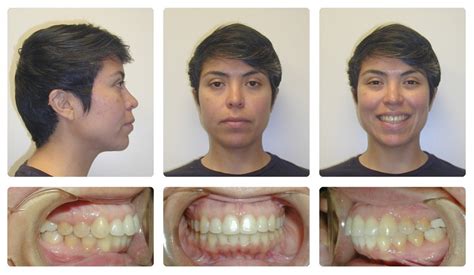 Braces Before And After Overjet