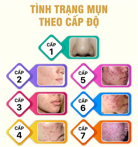 Phương Pháp Số 1 Về điều Trị Mụn Trứng Cá Tại Thanh Hóa