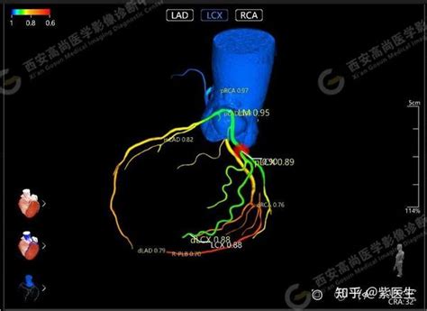 高尚医学影像之冠状动脉ct血流储备分数ai定量分析（ct Ffr） 知乎