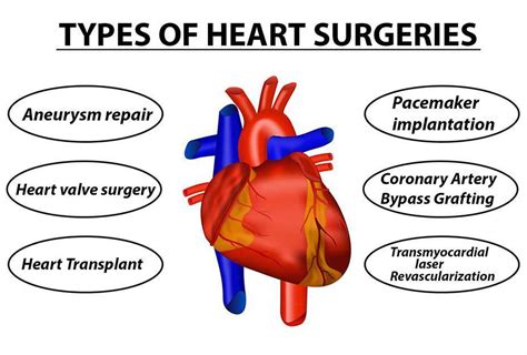 Heart surgery in Iran - Types, Recovery, & Risks 2023 - irantreatments ...