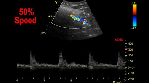 Normal Abdominal Aorta Ultrasound