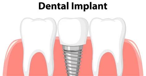 What Are Dental Implants Procedure Advantages Risks Ekdantam